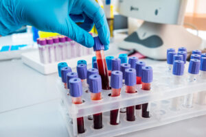 Xét nghiệm WBC giúp đánh giá số lượng bạch cầu, hỗ trợ phát hiện nhiễm trùng, viêm và theo dõi một số vấn đề sức khỏe